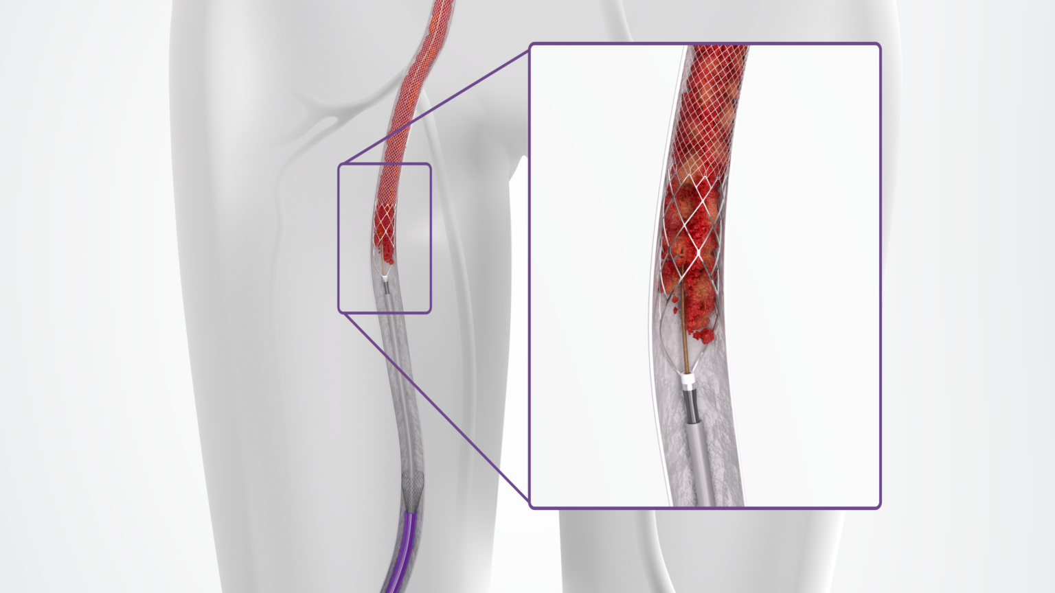 Mechanical Thrombectomy Shifts The Needle Toward Interventional