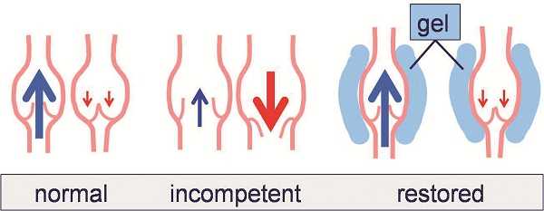 Extraluminal valvuloplasty by perivenous gel injection