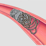 penumbra-launches-pod-packing-coil-for-peripheral-vessel-and-aneurysm-embolisation