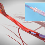 silk-road-medical-announces-first-us-commercial-case-with-the-enroute-transcarotid-stent-system
