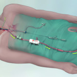 silk-road-medical-receives-up-to-us57-million-investment-to-continue-us-market-introduction-of-enroute-transcarotid-nps-and-stent-systems