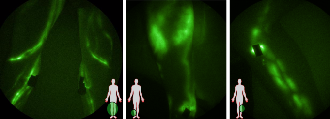 Lymphatic abnormalities and dysfunction in peripheral arterial and venous diseases