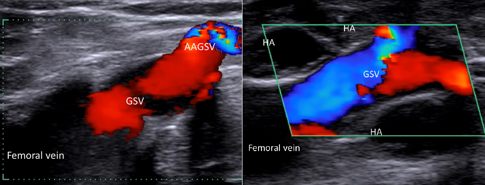 Ragg - pre and post-percutaneous valvuloplasty