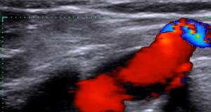 Vein reflux