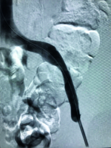 Figure 2: Final venogram of the implanted blueflow stent in the external iliac vein