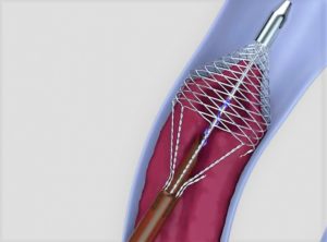 Vetex thrombectomy catheter (Vetex Medical)