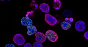 Human colorectal cancer cells