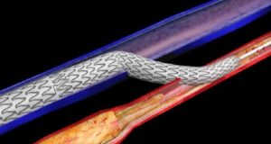 deep vein arterialisation