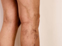 DVT