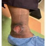 Figure 2 Ulcer at left medial malleolus at presentation.
