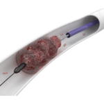 FlowTriever device (1)