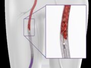ClotTriever “makes fast, safe and efficient thrombectomy possible”