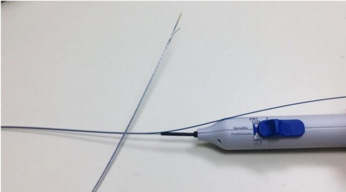 Intravenous anaesthesia delivery during varicose vein treatment proves safe and reduces pain scores, researcher reports anesthesia