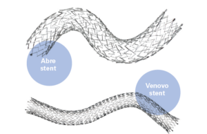 Nitinol stents placed in iliac veins “not associated with prolonged back pain,” study finds