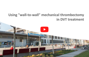 Using “wall-to-wall” mechanical thrombectomy in DVT treatment