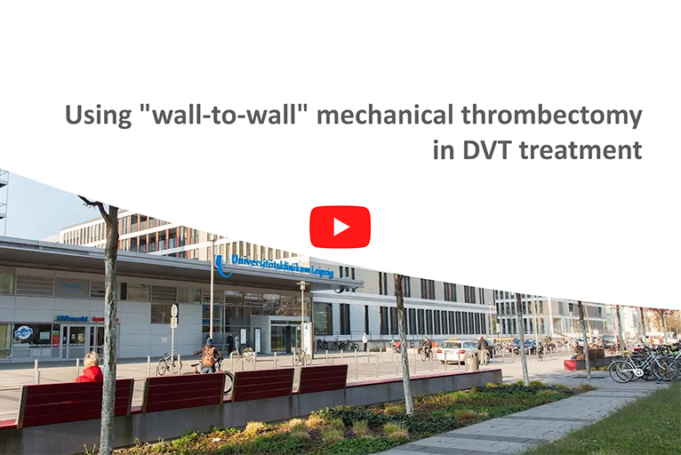 Using “wall-to-wall” mechanical thrombectomy in DVT treatment