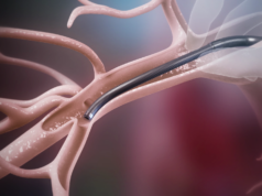 Jupiter Endovascular announces US FDA approval for SPIRARE II pivotal trial