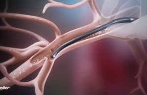 Jupiter Endovascular announces US FDA approval for SPIRARE II pivotal trial