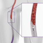 NEW-ClotTriever-in-Anatomy.png