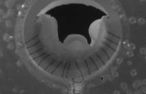 One-year data from the VenoValve US pivotal trial emerge