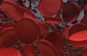 New Medicare analysis shows increased thrombectomy use in venous disease