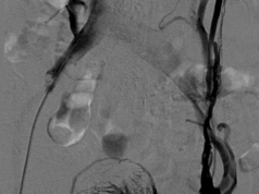 Raising awareness of pelvic venous disease in women