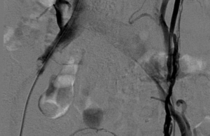 Raising awareness of pelvic venous disease in women